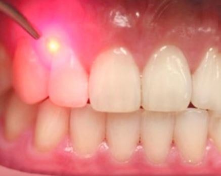 Laser Periodontal Therapy Long Island